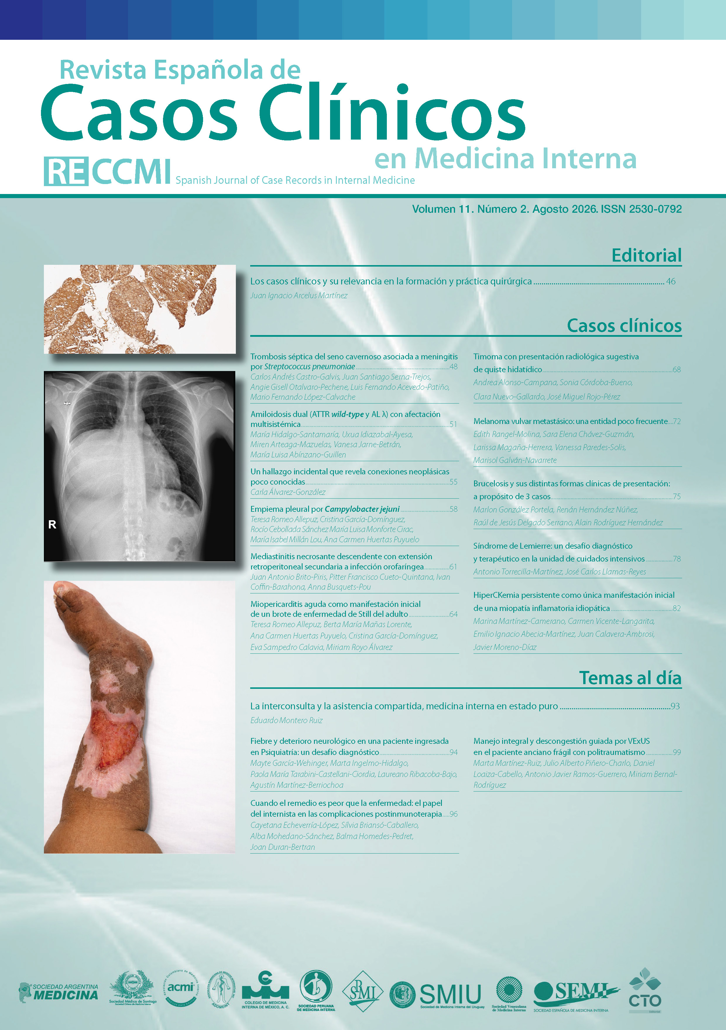 					Ver Vol. 11 Núm. 2 (2026): Revista Española de Casos Clínicos en Medicina Interna
				